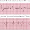 Understanding Premature Ventricular Complexes (PVCs)