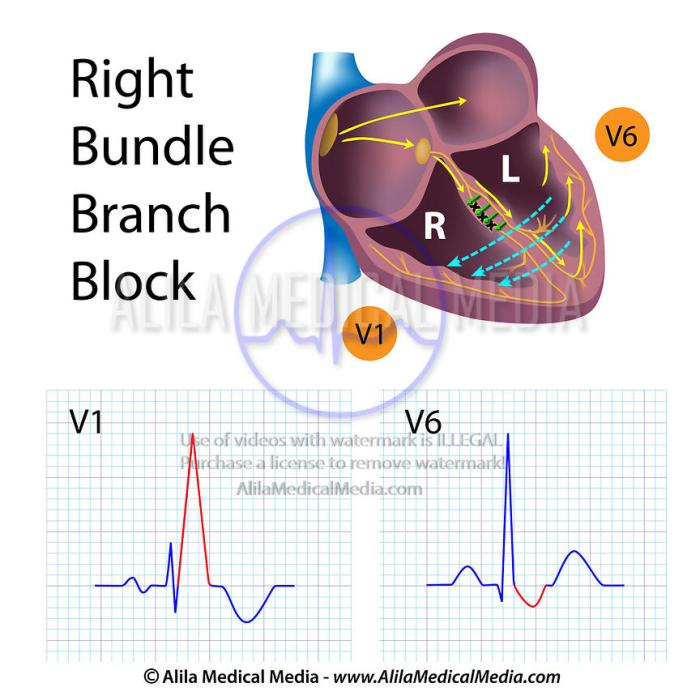 Right Bundle Branch Block Right bundle branch block rbbb