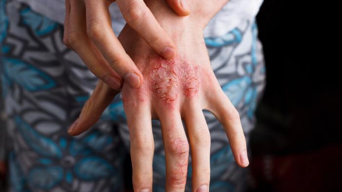 Atopic Dermatitis vs Eczema A Deep Dive