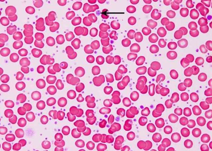 Treatments for essential thrombocythemia