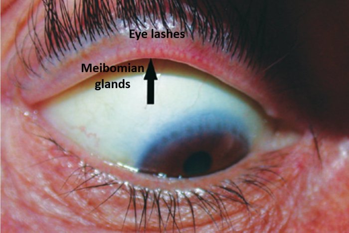Bug bite on eyelid