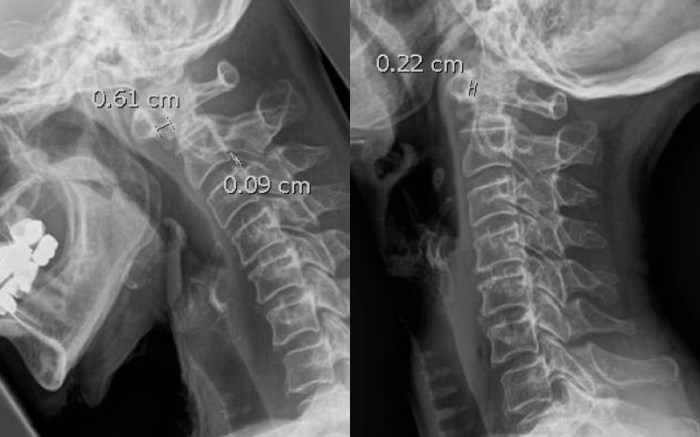 Rheumatoid arthritis in the neck