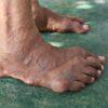 Gout in the Fingers Overview and More