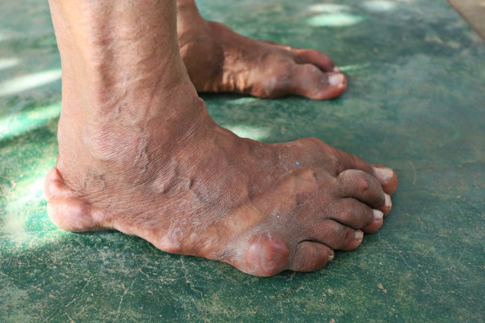 Gout in the fingers overview and more