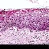 What is Cervical Intraepithelial Neoplasia? A Deep Dive
