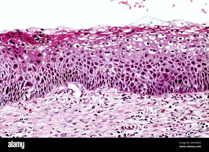 What is cervical intraepithelial neoplasia