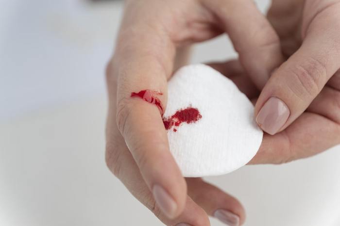 Hemophilia b overview and more