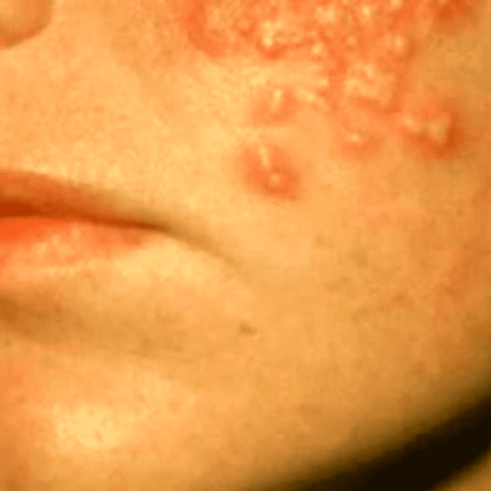 Hiv Rashes On Face Ask an expert hiv support groups