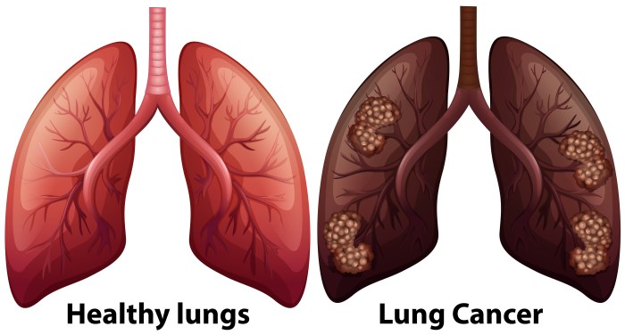 Lung cancer with an egfr mutation