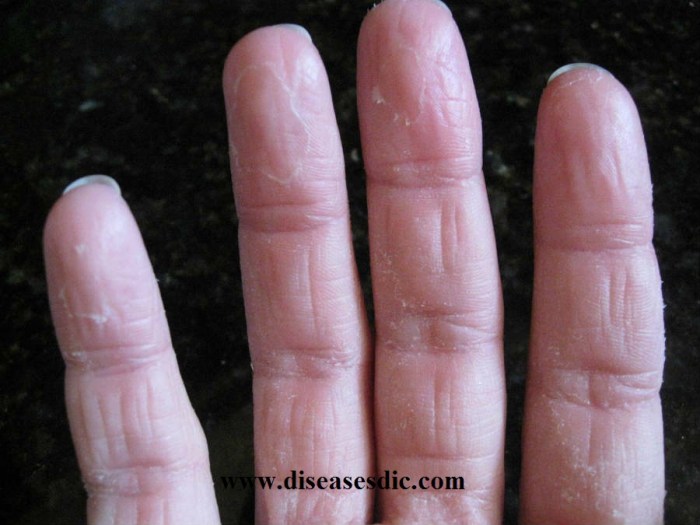 What is acral peeling skin syndrome
