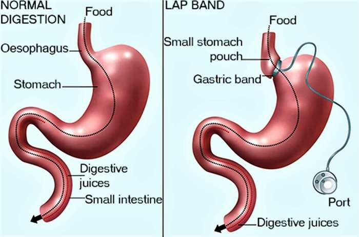 Types of weight loss surgery