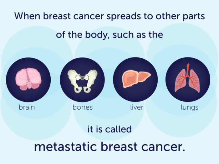 Metastatic Breast Cancer Awareness Day - Community Health Works Metastatic breast cancer resources