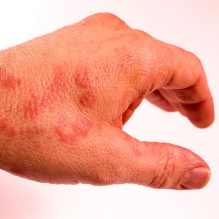 Zona : quels sont les symptômes et les traitements? Signs metformin not working