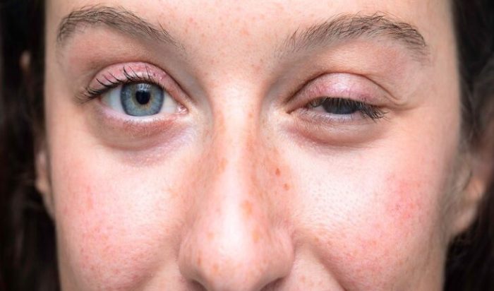 How myasthenia gravis is diagnosed