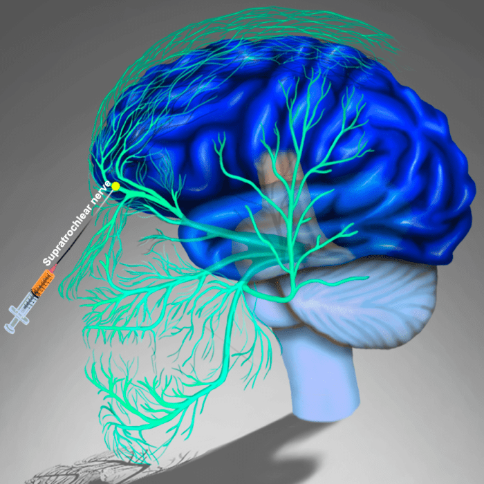 Migraine Nerves – Supratrochlear Nerve Block – Mrimigraine.com