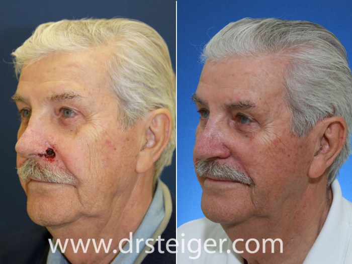 Mohs Surgery on Nose A Comprehensive Guide