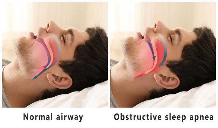 Types of sleep apnea