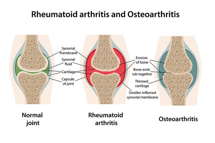 Rheumatoid arthritis vs arthritis
