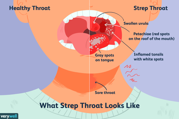Feeling of something stuck in throat