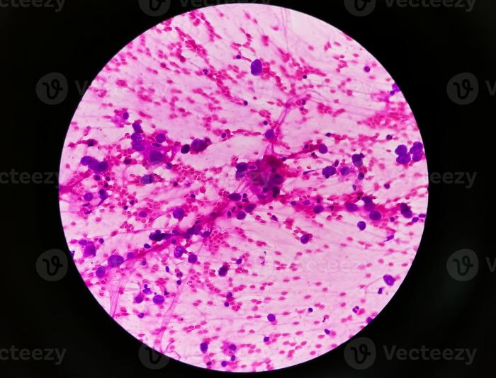Metastatic adenocarcinoma overview and more