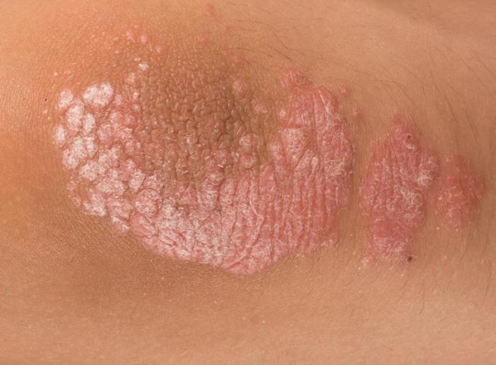 Mild Psoriasis: Types, Symptoms, and Treatment Psoriasis and your life