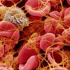 Platelet Counts in Rheumatoid Arthritis A Deep Dive