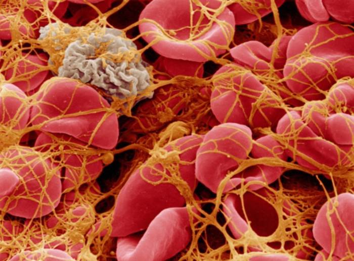 Platelet counts in rheumatoid arthritis
