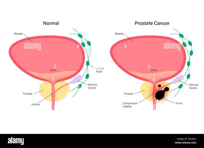 Enlarged Prostate (Benign Prostatic Hyperplasia) | My Doctor Online Prostate cancer survival rate