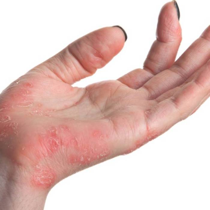 National action plan must stop the rapid advance of scabies - TIme News Congenital adrenal hyperplasia symptoms