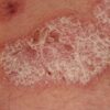 Psoriasis and Your Life A Deep Dive