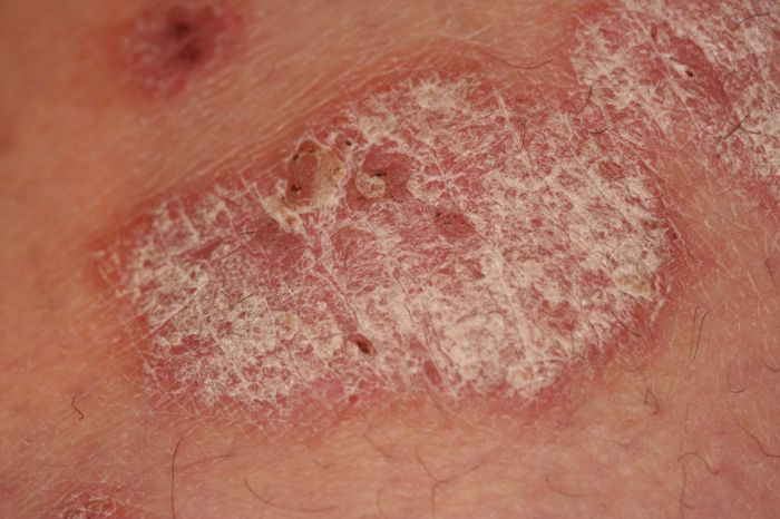 Kim Kardashian Shares New Pic Of Psoriasis As She Continues To Battle With The Skin Condition ... Psoriasis and your life