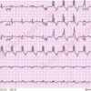 Right Bundle Branch Block (RBBB) A Comprehensive Guide