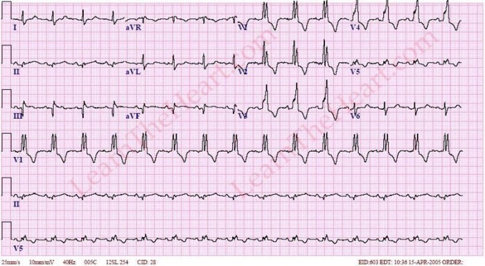 Right bundle branch block Right bundle branch block rbbb
