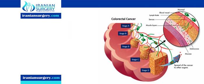 Rectal Cancer Survival Rates and the Factors that Influence Them (2023) Rectal cancer survival rates