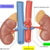 What is Renal Artery Stenosis? A Deep Dive