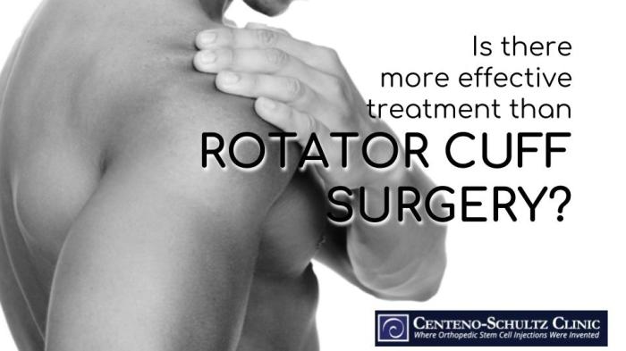 Surgery Not Needed for Rotator Cuff Tears Alternatives Explored
