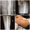 Removing Metal Plates, Screws, Rods After Surgery