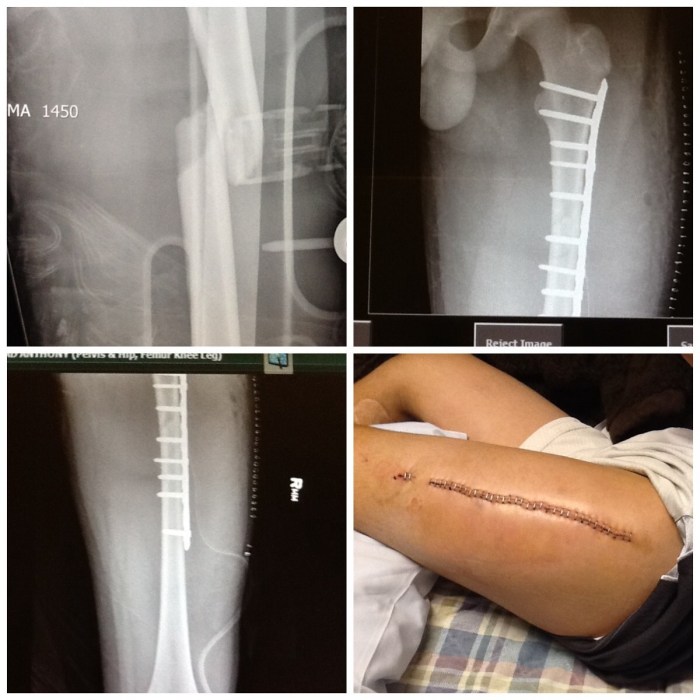 Removing metal plates screws rods after surgery