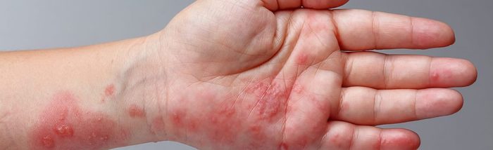 Shingles, Zoster or Herpes Zoster Symptoms on Arm Stock Image - Image of elbow, herpes: 166919801 Signs of fibroids breaking down