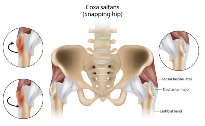 What Causes Hip Pain Radiating Down The Leg To The Knee? Hip pain that radiates