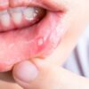 Sore Throat and Cough Understanding Causes and Relief
