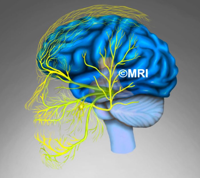 Nerve Block for Migraine A Deep Dive