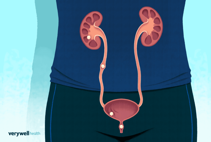 Stages of passing a kidney stone