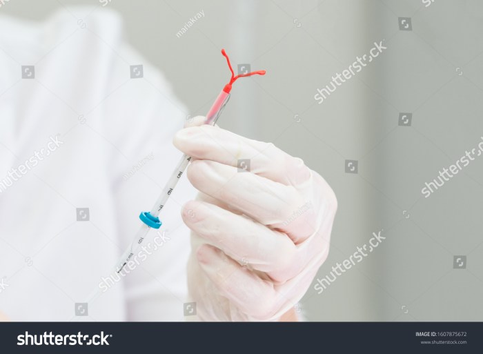 (PDF) Intrauterine device quo vadis? Why intrauterine device use should ... Iud use in nulliparous women