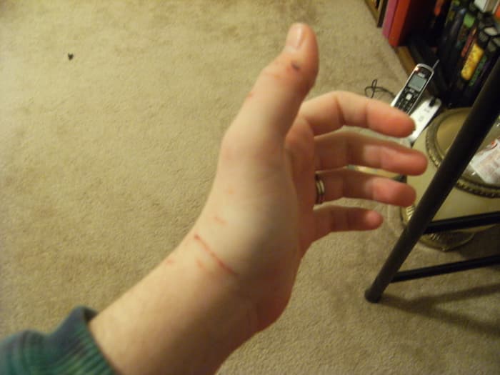 Treating Cat Bites and Scratches - HubPages How to treat cat bites and scratches