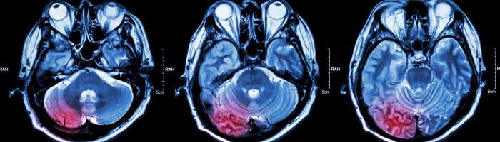 Migraine and multiple sclerosis connection