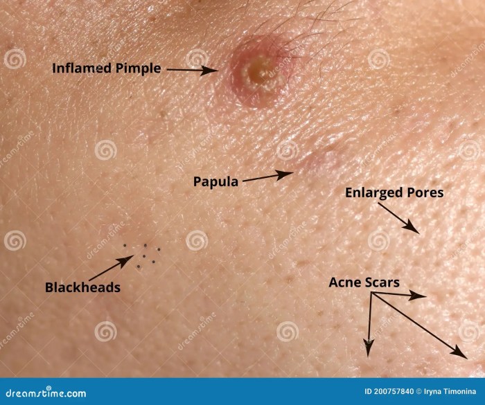 Papule definition of an acne papule