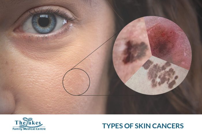 What is the Most Common Cancer in the US?