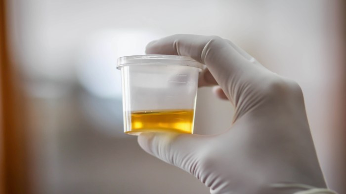 What Does a Urinalysis Test For? - GoodRx Urine glucose test what it measures results next steps