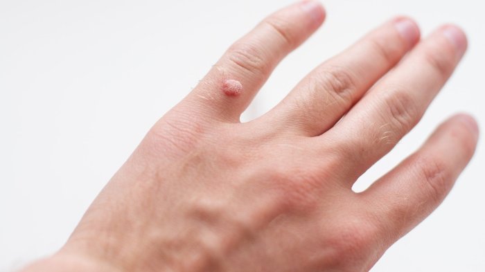 Human Papillomavirus Vaccines Hpv vaccine schedule age